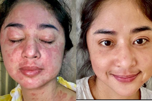 Lama Menghilang, Pas Muncul Muka Dewi Perssik Penuh Bercak Merah, Ternyata Positif Covid-19