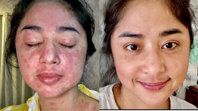 Lama Menghilang, Pas Muncul Muka Dewi Perssik Penuh Bercak Merah, Ternyata Positif Covid-19