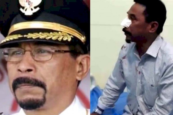 Tak Bayar Utang, Bos Tambang Gigit Hidung Eks Bupati Sampai Putus