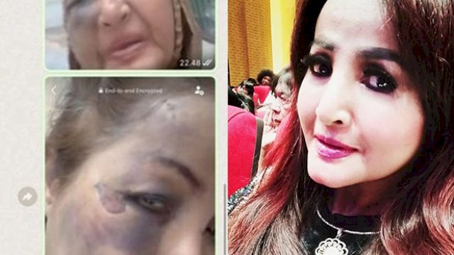 Machica Mochtar jadi korban tabrak Lari. (F-INT)