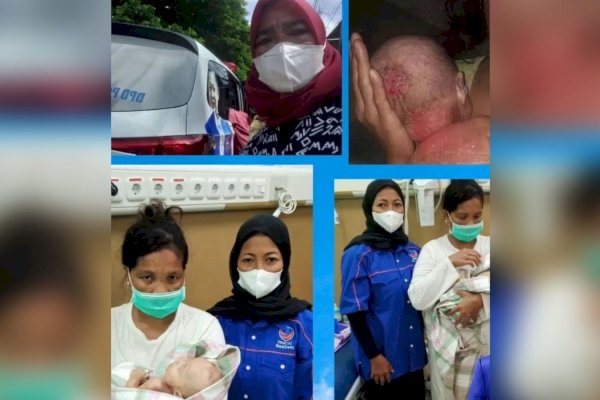 Viral Bayi Kulit Melepuh di Makassar Butuh Bantuan, Cepat Ditolong Kader NasDem Dibawa ke RS-Diberi Santunan
