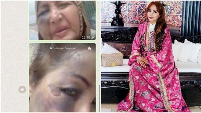 Penyanyi Lawas Machica Mochtar jadi korban tabrak larti sampai babak belur.(F-INT)