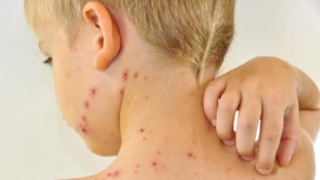 Cacar Monyet (ilustrasi)