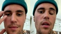 Ngeri! Terpapar Virus, Separuh Wajah Justin Bieber Lumpuh: Saya Tidak Bisa Tersenyum