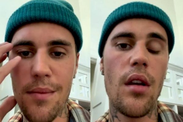 Ngeri! Terpapar Virus, Separuh Wajah Justin Bieber Lumpuh: Saya Tidak Bisa Tersenyum