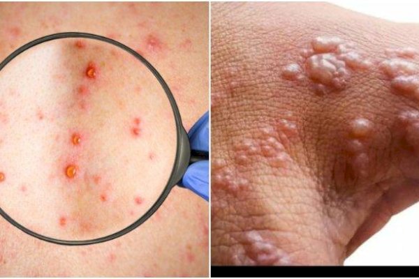 WHO Tetapkan Cacar Monyet Darurat Kesehatan Global