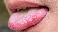 Jangan Keliru, Inilah Cara Membedakan Sariawan dan Gejala Kanker Lidah