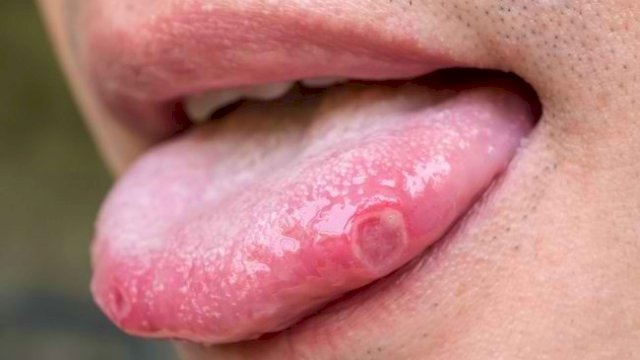 Ilustrasi Sariawan.(F-INT)