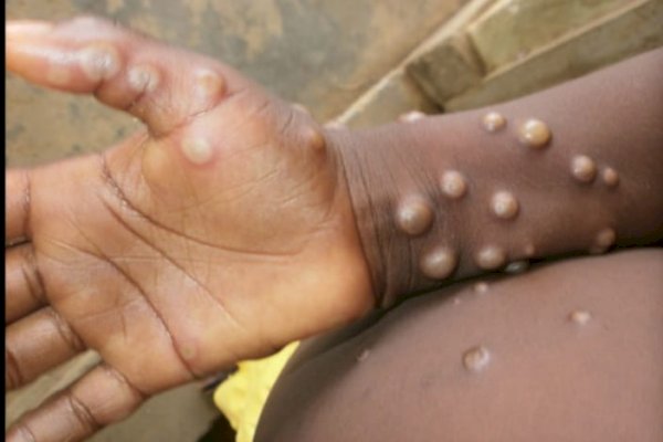 Tindak Lanjuti Peringatan WHO, IDI Bentuk Satgas Cacar Monyet