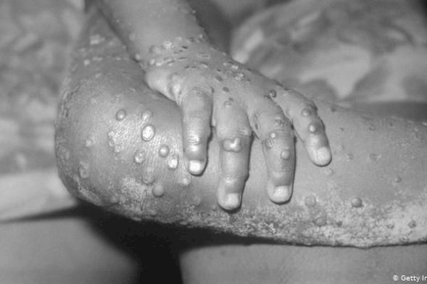 Waspada! Kasus Cacar Monyet Pertama Indonesia Ditemukan di Jakarta