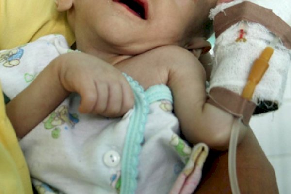 Pemkab Takalar Respon Cepat Berikan Pelayanan ke Balita Pengidap Gizi Buruk