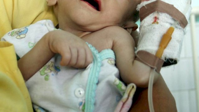 Ilustrasi Balita Gizi Buruk.(F-INT)