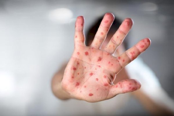 Daftar 55 KLB Campak di Indonesia, Tersebar di 12 Provinsi