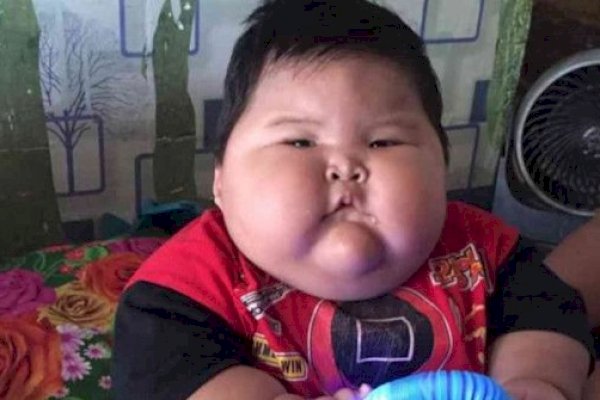 Kondisi Bayi Obesitas di Bekasi, 16 Bulan Beratnya 27 Kg