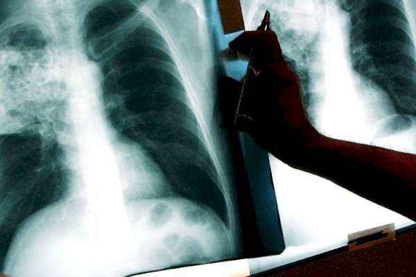 Dokter: Penyakit TBC Bukan Faktor Keturunan