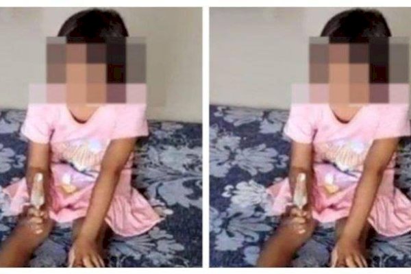 Miris! Mata Dicolok Tusukan Bakso Kakak Kelas, Siswi SD Gresik Buta Permanen, Ayah Korban: Trauma