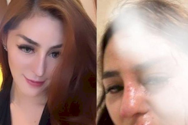 Tangis Safa Marwah Pecah Usai Curhat Dianiaya Pacar hingga Pelipis Sobek, PNS di Kemendagri