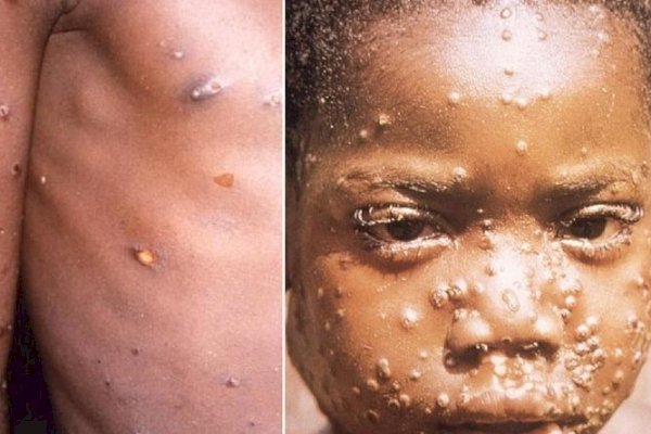 Sudah 55 Kasus Cacar Monyet di Indonesia, DKI Jakarta Terbanyak