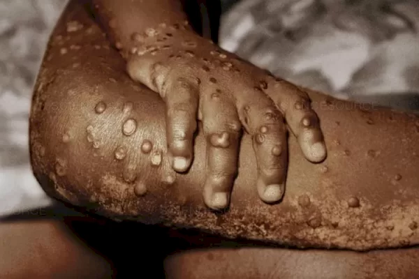 Waspada! Ada 88 Kasus Mpox di Indonesia hingga 17 Agustus, Seksual Sesama Jenis Jadi Salah Satu Penyebab