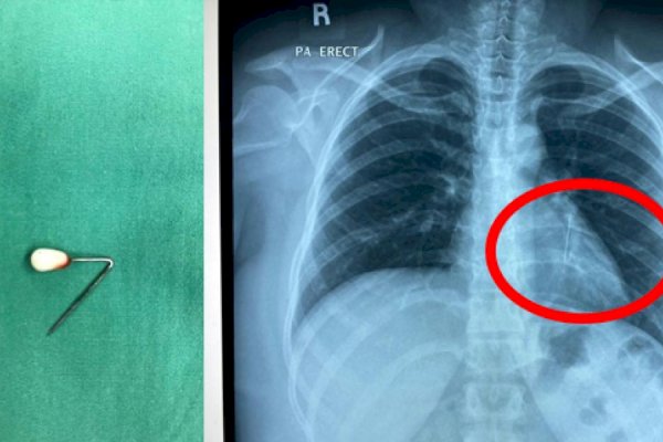 Waspada, Jarum Pentul Tertelan saat Pakai Hijab-Dikeluarkan dari Lambung